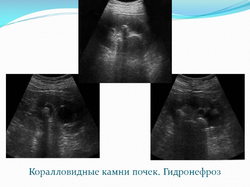 Коралловидные камни почек. Гидронефроз